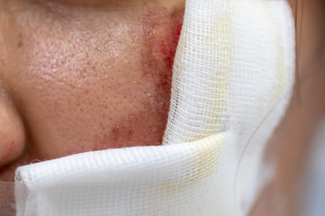 Closeup injured at leg, Fresh wounds from accident. 