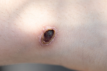 Closeup injured at leg, Fresh wounds from accident. 