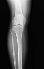 normal x-ray of the knee joint