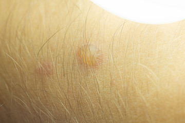 blister on the skin, burns with hot water, oil.