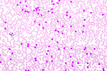 Picture of leukemia cells in blood smear, analyze by microscope, 400x