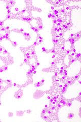 Picture of leukemia cells in blood smear, analyze by microscope, 400x