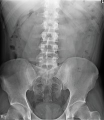 radiograph of the lumbar spine in direct projection