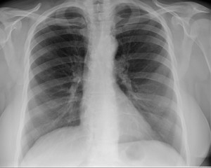 normal radiography of the chest and lungs