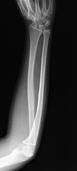 normal radiography of forearm bones with elbow and wrist joints