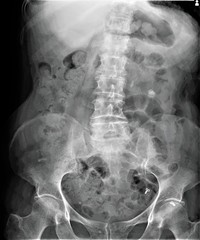 radiograph of the lumbar spine in direct projection