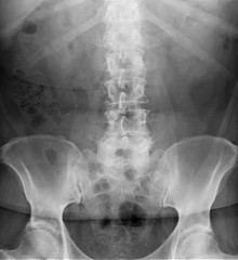radiograph of the lumbar spine in direct projection