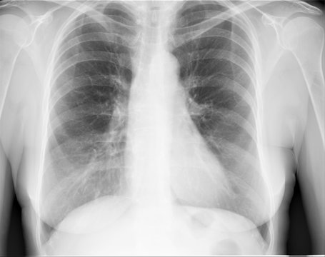 normal radiography of the chest and lungs