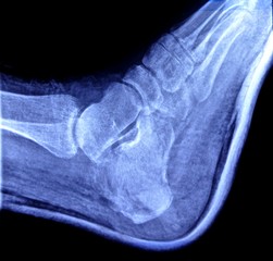 radiography to the right heel
