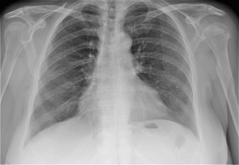 normal radiography of the chest and lungs
