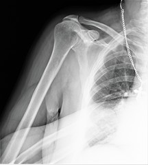 normal x-ray of the shoulder joint