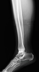 normal radiograph of the ankle joint