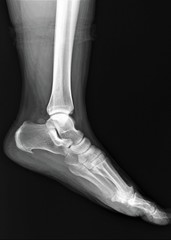 normal radiograph of the ankle joint