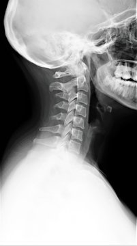 radiograph of the cervical spine in the lateral projection