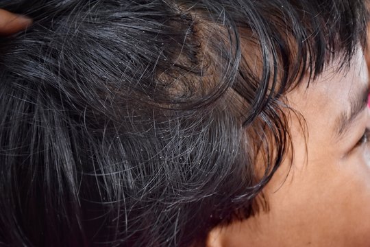 the black hair on the child's head is full of louse egg