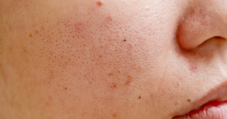 acne on the woman face