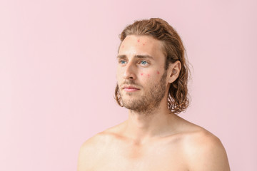 Portrait of young man with acne problem on color background