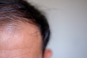 Fototapeta premium young man of baldness and health and medicine concept