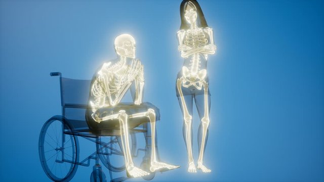 man in wheelchair with visible bones