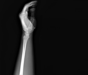 normal radiography of hand and wrist bones, traumatology and orthopedics, traumatology, sports injury