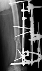 on the radiograph of the femur unconsolidated fracture of the femoral diaphysis is fixed by an external fixation device. medicine, diagnostics, traumatology, orthopedics