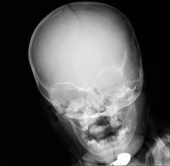 normal radiography of the paranasal sinuses of the facial skull