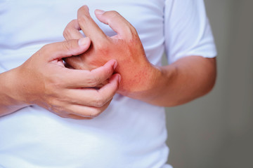 Itching of skin diseases in men using the hand-scratching. Red around the Itching area.