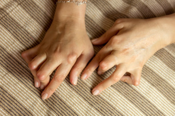 Young woman having rheumatoid arthritis. Hands and legs are deformed. She feels pain. Selective...