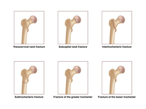 Six types of femoral neck fracture. Realistic drawing showing broken bone with inscriptions isolated on whie background.