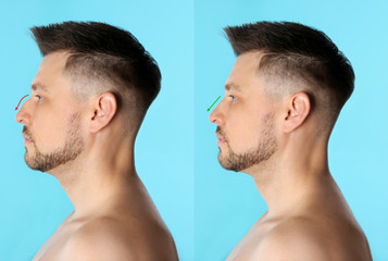 Fototapeta premium Man before and after plastic surgery on light blue background