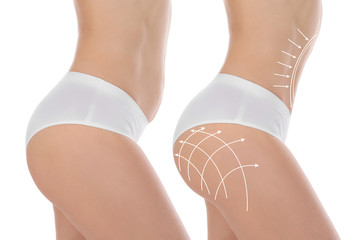 Young woman before and after plastic surgery on white background