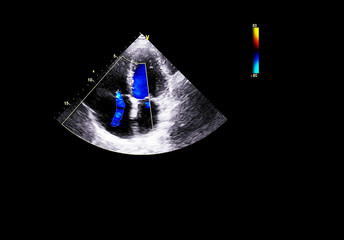 Screen of echocardiography (ultrasound) machine.