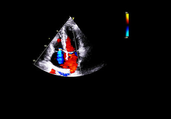 Screen of echocardiography (ultrasound) machine.