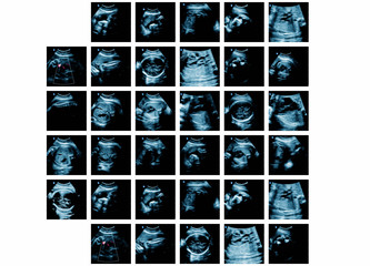Series of ultrasonography fetus images. Pregnancy on 7th month