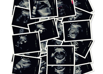 Ultrasound pictures composition. Pregnancy concept, 4th month fetus