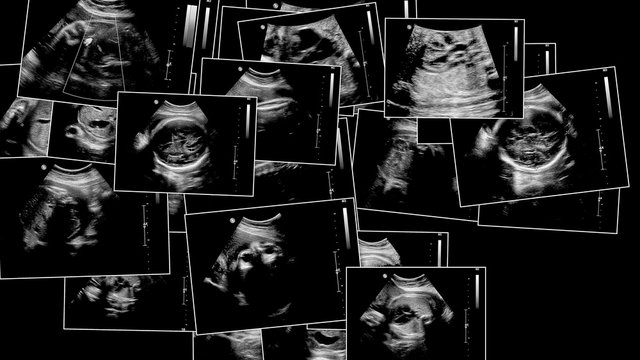 Series of ultrasonography fetus images. Pregnancy on 7th month