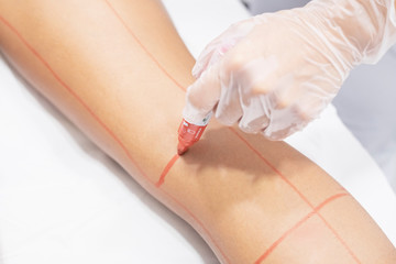 laser hair removal for women