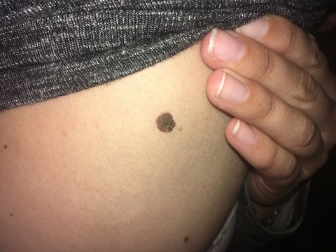 Frau begutachtet einen Leberfleck