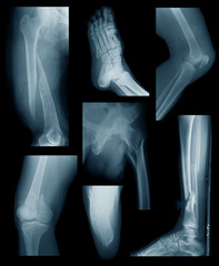Collection X-ray image show lower limb or lower extremity fractures