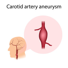 Carotid artery aneurysm. Widening of the vessel. Medical illustration.