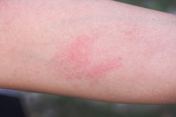Fototapeta premium Asian woman has red rash on her arm