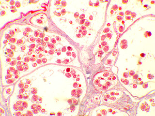 Hydatid cyst under the microscope (100x). Echinococcus granulosus. Dog tapeworm parasite.
