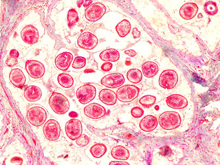 Echinococcal cyst under the microscope (400x). Echinococcus granulosus. Dog tapeworm parasite.