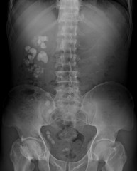 X-ray image of urinary system (kidnery, urinary and bladder: KUB), showing kidney stones, or renal calculi in right side