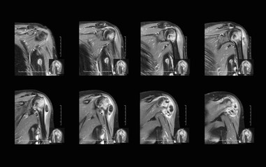 Magnetic resonance imaging (MRI scan) of shoulder Joint pain, coronal view