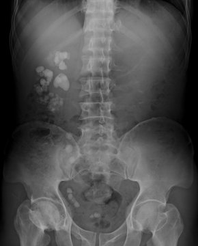 X-ray image of urinary system (kidnery, urinary and bladder: KUB), showing kidney stones, or renal calculi in right side