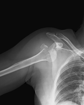 X-ray image of shouldle joint, Antero-posterior (AP) view, showing proximal humerus fracture and dislocation