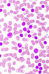 Blood picture of chronic lymphocytic leukemia or CLL, analyze by microscope, original magnification...
