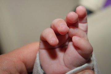  Polydactyly  Preaxial, Polydactyly on human; rare abnormal characteristic causes by chromosome,...