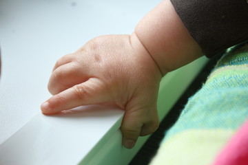  Polydactyly  Preaxial, Polydactyly on human; rare abnormal characteristic causes by chromosome, Disorders of Hands, six fingers in one hands